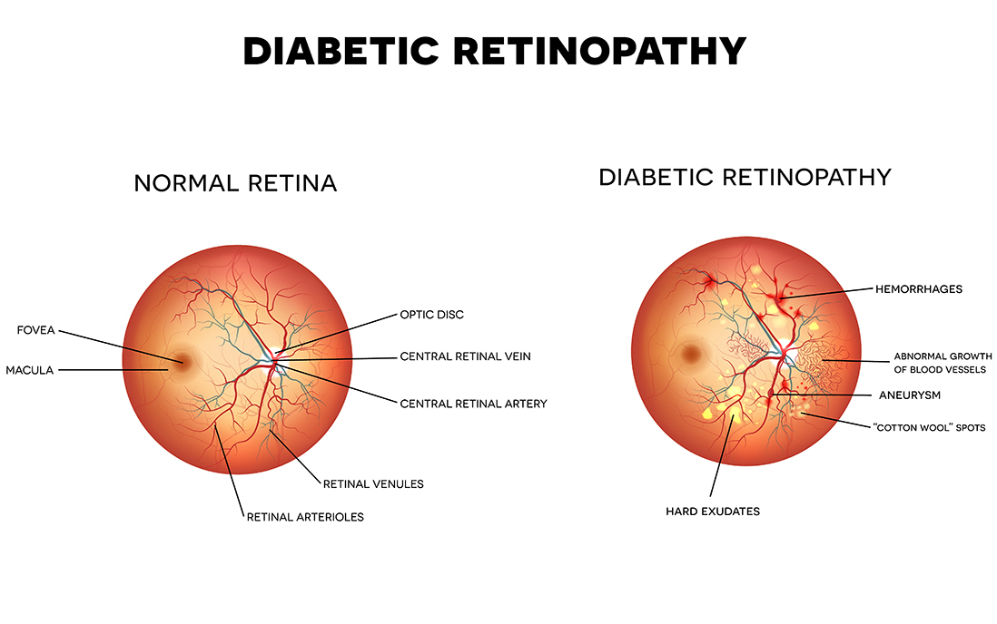 Diabetic-Retinopathy 2