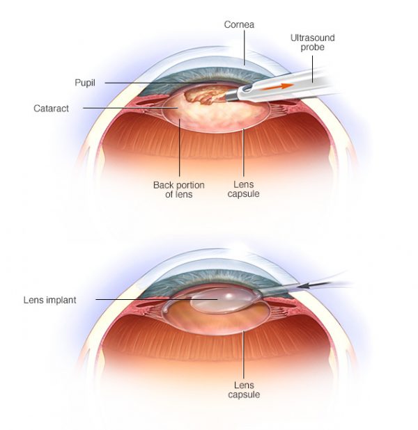 cataract.vs normaljpg