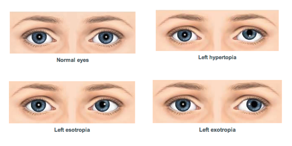 වපරය - Are you suffering from squint