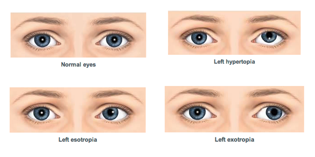 Squint Eye Clinic